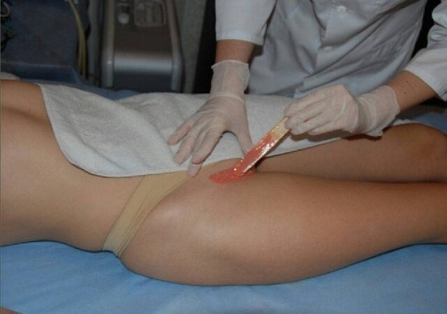 Бразильская эпиляция: все, что нужно знать о процедуре