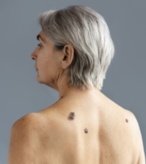 Когда родинка на спине вызывает тревогу: что нужно знать